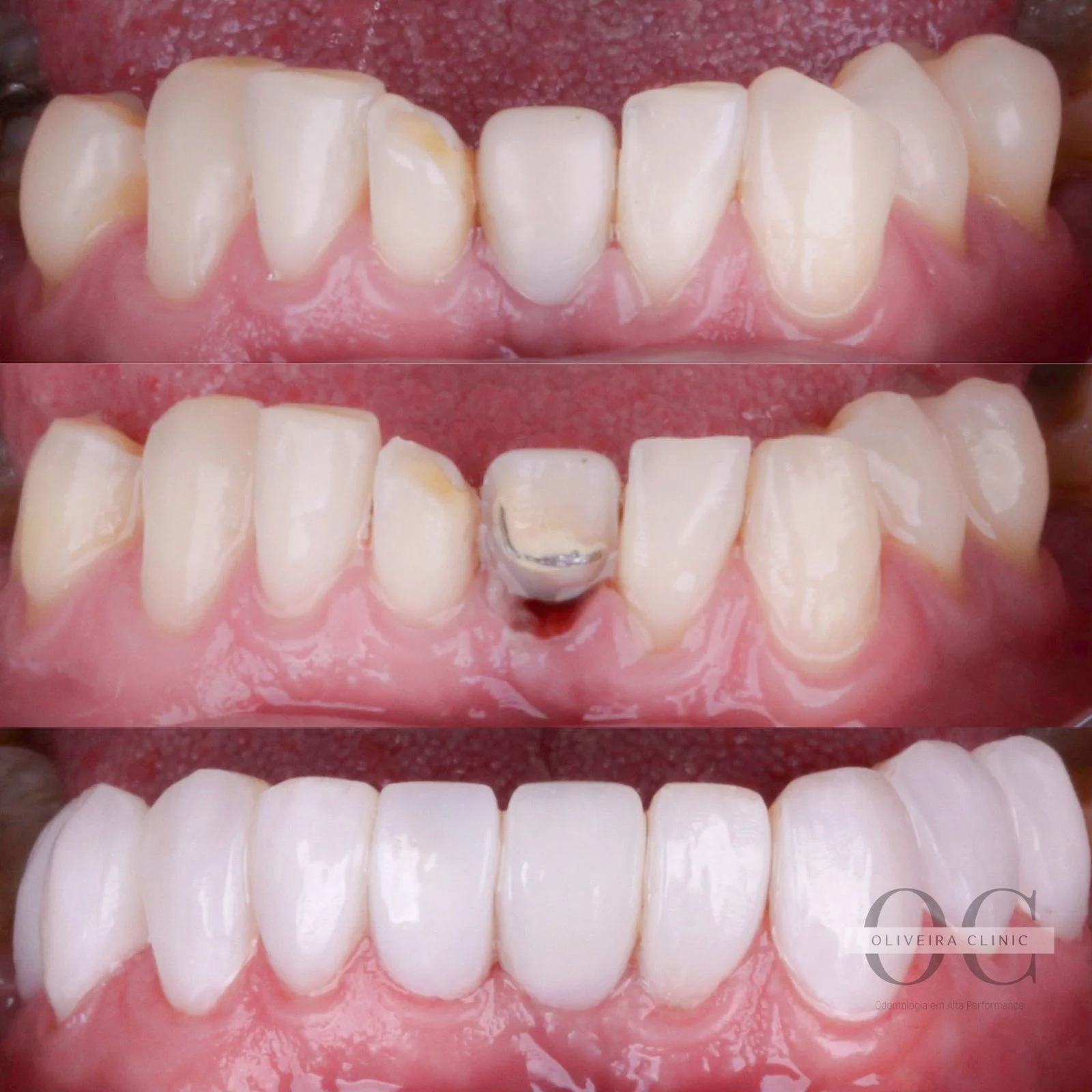 Antes e depois — Implante + Coroa Cerâmica