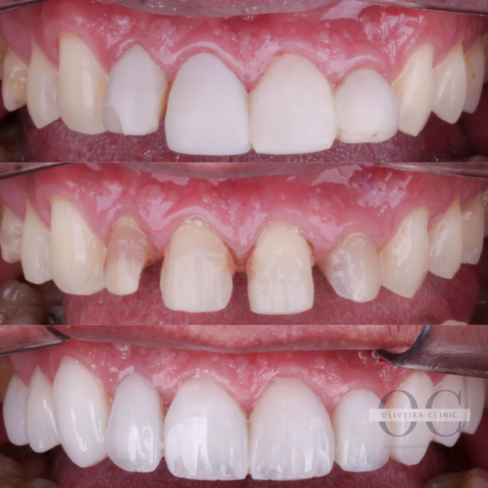 Antes e depois — Fechamento de Diastemas