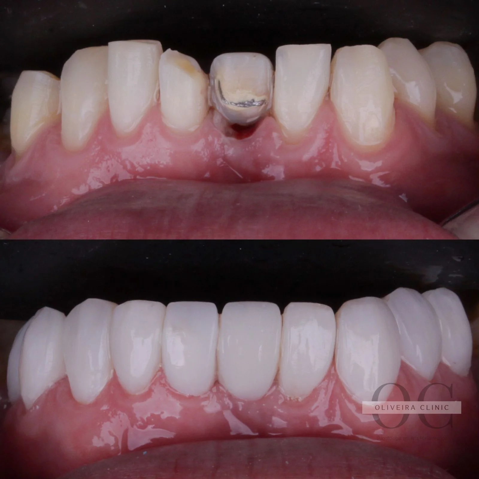 Antes e depois — Reabilitação Estética Anterior