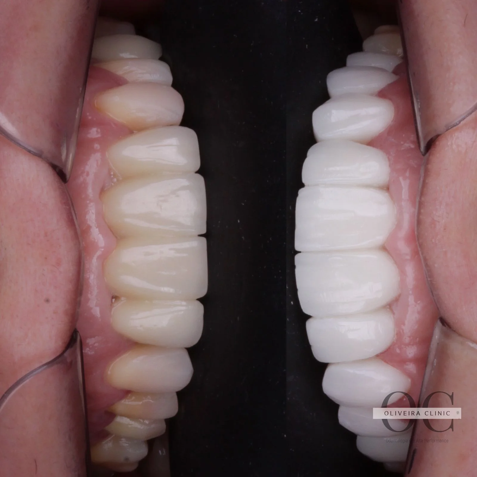 Comparativo Antes e Depois