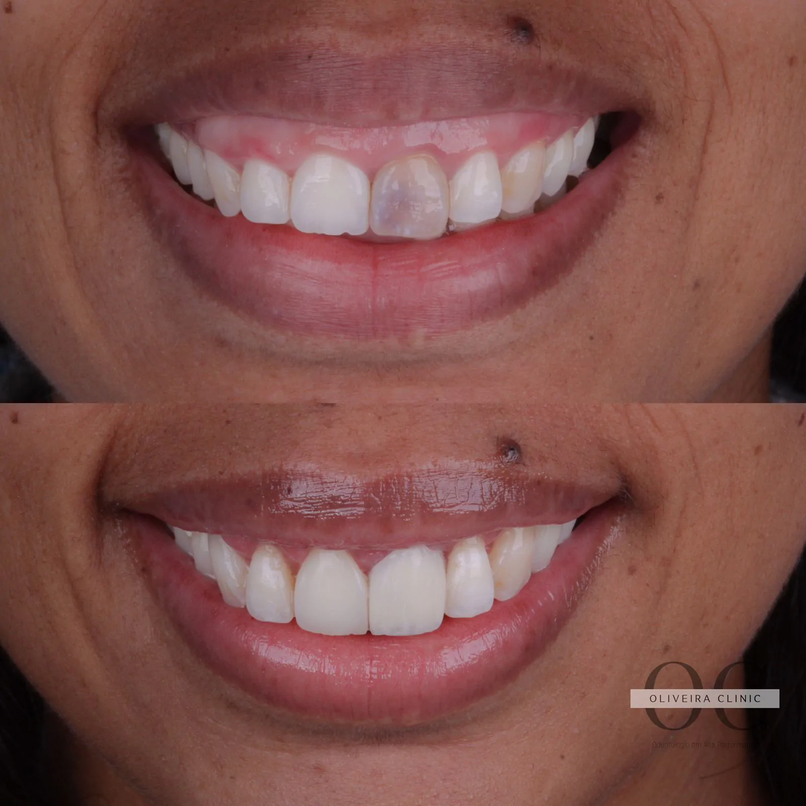 Antes e depois de plástica gengival com laser de alta potência corrigindo sorriso gengival na Oliveira Clinic
